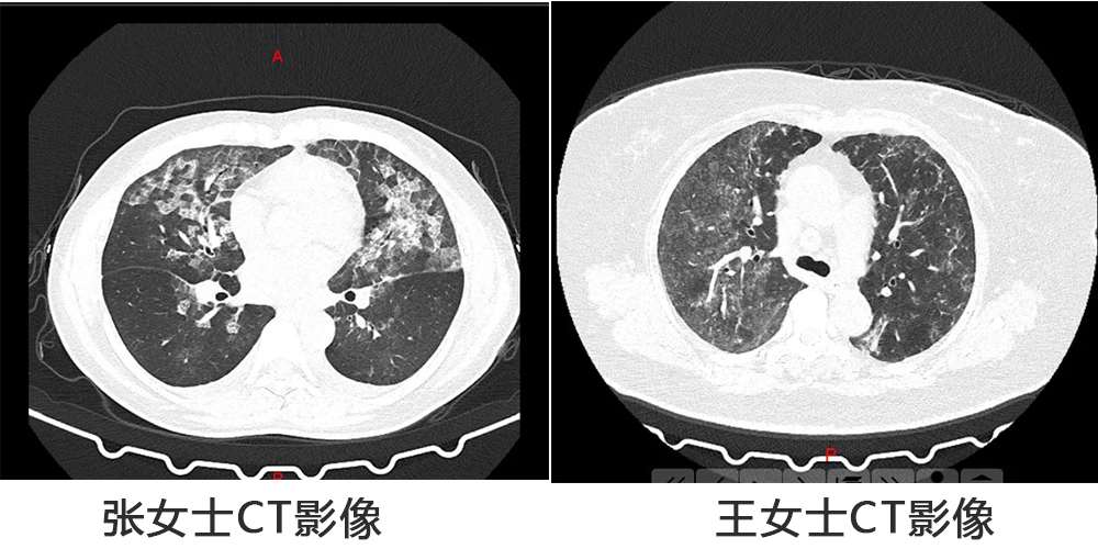 消毒过量，河南两女子肺部CT呈现毛玻璃状！